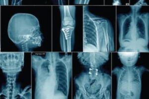 xrays